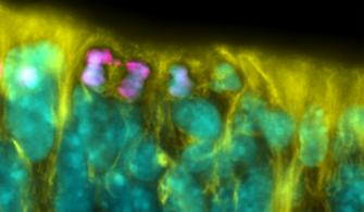 Chromosomensegregationsfehler in einer sich teilenden neuralen Stammzelle (magenta) während der Neurogenese im sich entwickelnden Gehirn einer Maus
